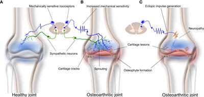 Mini review: The role of sensory innervation to subchondral bone in osteoarthritis pain